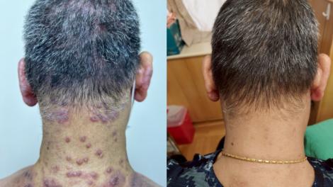 老翁「異位性皮膚炎」搔癢難以入眠　醫生一招讓他恢復生活品質