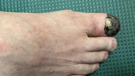 恐怖！76歲翁以為「腳趾瘀青」範圍竟擴大　就醫才發現是「這種病」