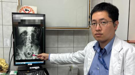 瓷杯爆菊花！男3天無法排便　醫開刀急取出