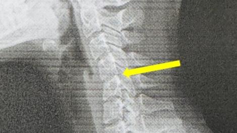 20歲女子頸椎「老化成60歲」竟是這原因！醫生示警了