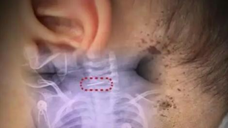 10月大男嬰被母親「狠扎數百針」　母親喊冤：我在治療他