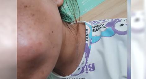 永遠留疤！23歲女擠痘痘半邊臉感染「變恐怖豬頭」　開刀清創縫6針