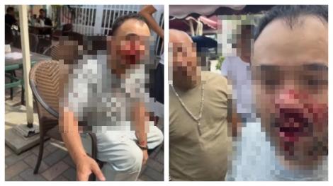 YTR直播吃飯「光頭男一拳拳開扁」！　鏡頭一晃...他整臉都是血