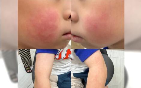 日本返台出現「蘋果病」！　兒童感染專科醫師：機率很高