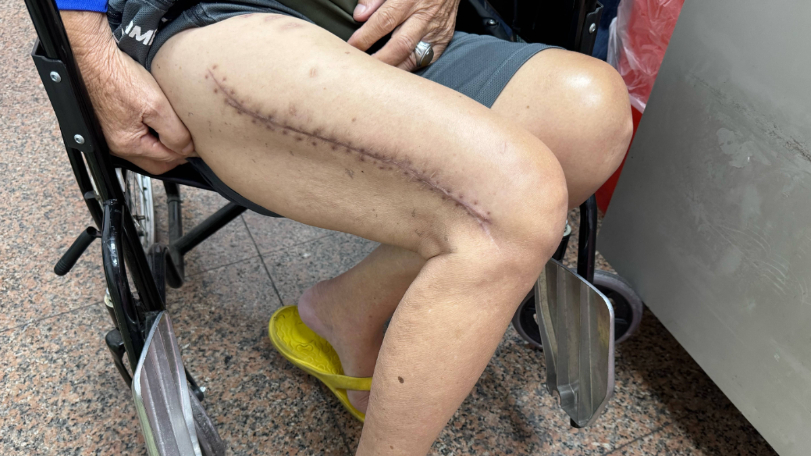 8旬翁大腿斷三截　三次術後喊「我要再參加媽祖遶境」