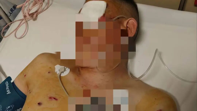 男子到銀行提750萬遭搶！被打到左眼失明　痛斥：銀行保安沒幫忙