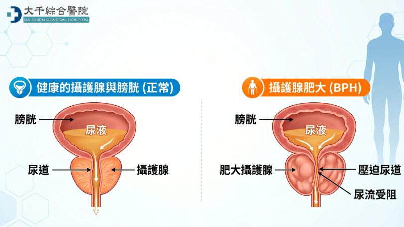 男性50歲後的難言之隱！留意攝護腺肥大警訊　置之不理恐釀危機