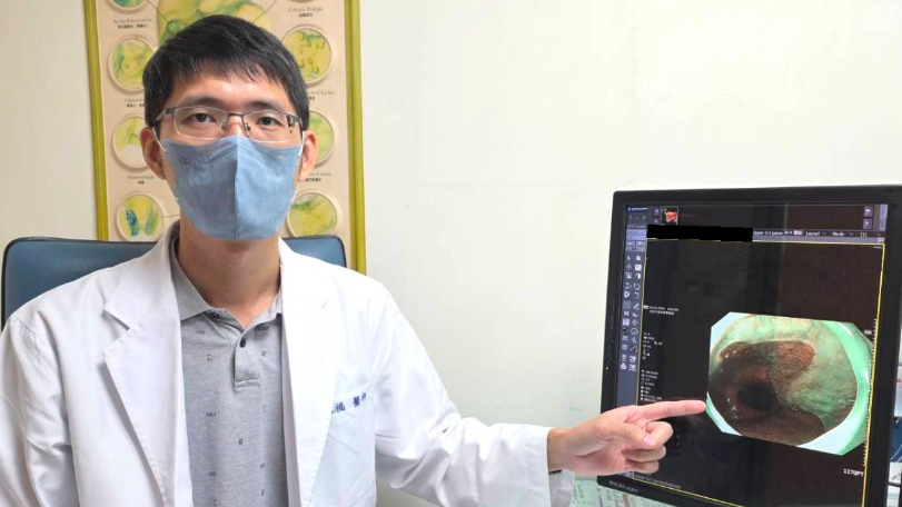 胃食道逆流！六旬婦檢查驚見癌前病變！「內視鏡射頻消融術」及時阻斷癌化風險